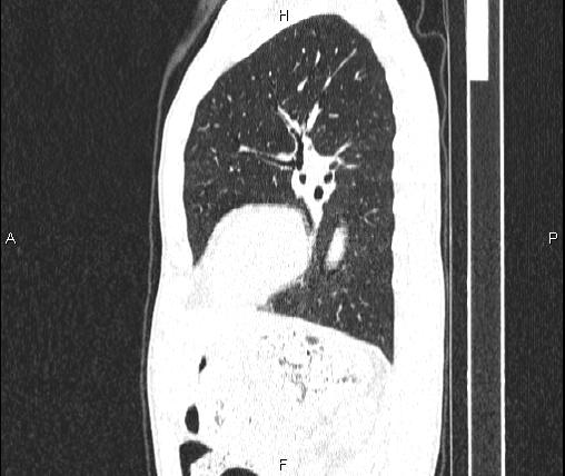 Air bronchogram in pneumonia (Radiopaedia 85719-101512 Sagittal lung window 67).jpg