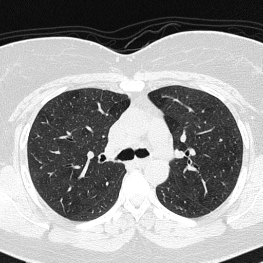 Air trapping in small airway disease (Radiopaedia 61685-69694 Axial lung window 60).jpg