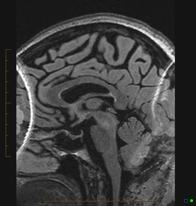 Aliasing artifact causing a spurious cerebellar lesion (Radiopaedia 48783-53810 Sagittal FLAIR 42).jpg