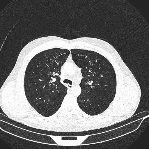 File:Allergic bronchopulmonary aspergillosis (Radiopaedia 21386-21320 Axial lung window 13).jpg