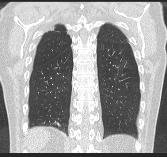 Allergic bronchopulmonary aspergillosis (Radiopaedia 44760-48571 Coronal lung window 47).png
