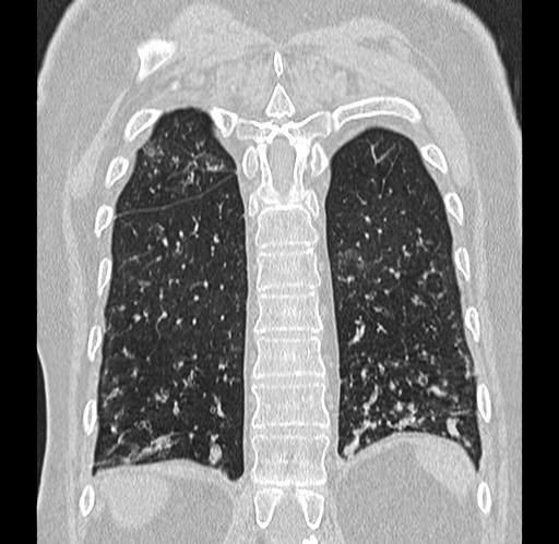 Alpha-1-antitrypsin deficiency (Radiopaedia 72058-82557 Coronal lung window 82).jpg