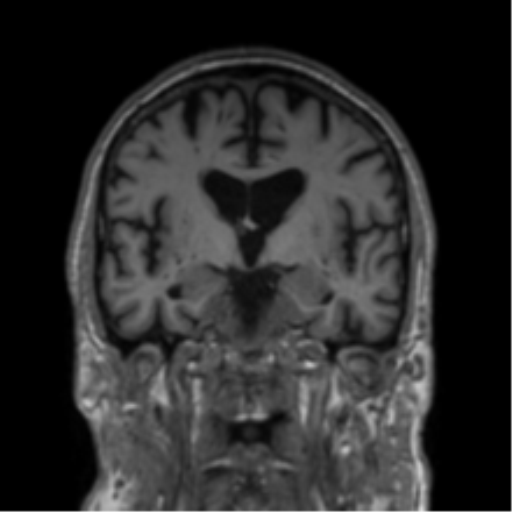 Alzheimer's disease- with Gerstmann syndrome and dressing apraxia (Radiopaedia 54882-61150 Coronal T1 50).png