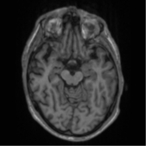 Alzheimer's disease- with apraxia (Radiopaedia 54763-61011 Axial T1 30).png