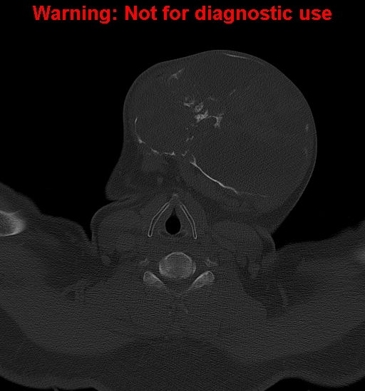 Ameloblastoma (Radiopaedia 33126-34164 Axial bone window 29).jpg