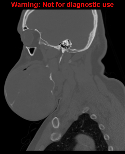 Ameloblastoma (Radiopaedia 33126-34164 Sagittal bone window 27).jpg