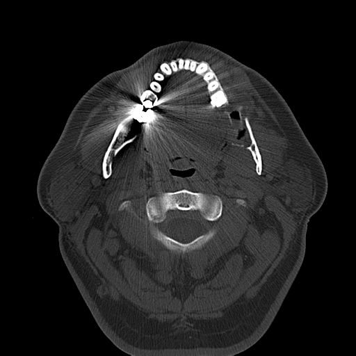 Ameloblastoma (Radiopaedia 38520-40623 Axial bone window 28).png