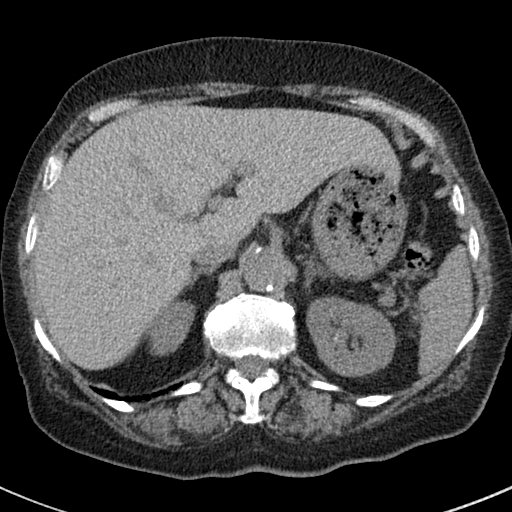 File:Amiodarone-induced pulmonary fibrosis (Radiopaedia 82355-96460 Axial non-contrast 58).jpg