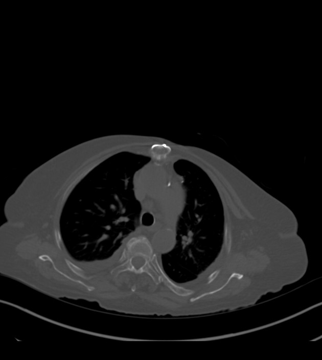 Amiodarone deposition in the liver (Radiopaedia 77587-89780 Axial bone window 27).jpg