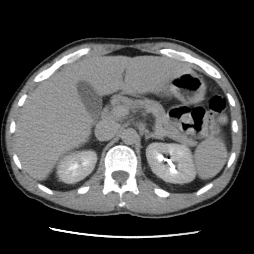 Amoebic liver abscesses (Radiopaedia 55536-62009 Axial C+ delayed 30).jpg