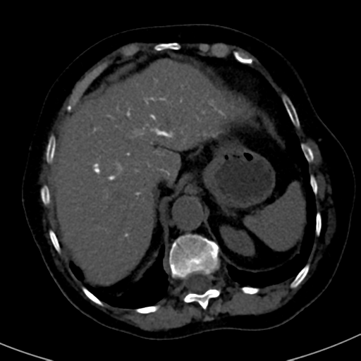 File:Ampullary adenocarcinoma (Radiopaedia 34013-35241 AXIAL THICK 15).png