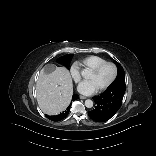 Ampullary adenocarcinoma (Radiopaedia 59373-66734 C 18).jpg