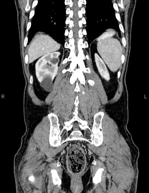 Ampullary adenocarcinoma (Radiopaedia 86093-102032 C 55).jpg