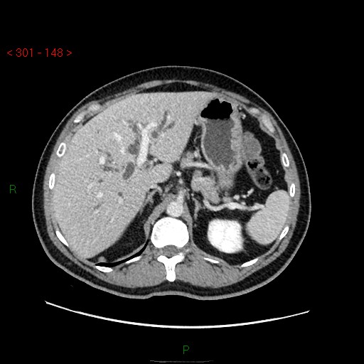 Ampullary carcinoma (Radiopaedia 56396-63056 C 26).jpg