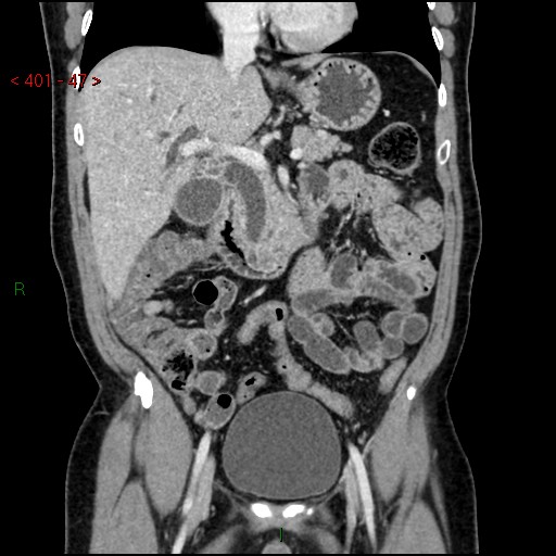 Ampullary carcinoma (Radiopaedia 56396-63056 E 46).jpg