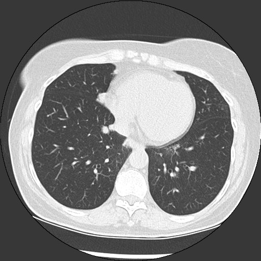 Amyloidosis - bronchial and diffuse nodular pulmonary involvement (Radiopaedia 60156-67744 B 40).jpg