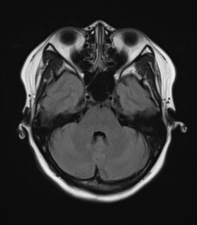 File:Anaplastic astroblastoma (Radiopaedia 55666-62194 Axial FLAIR 8).png