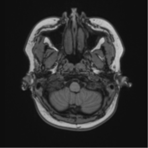 Anaplastic astroblastoma (Radiopaedia 55666-62194 Axial T1 9).png