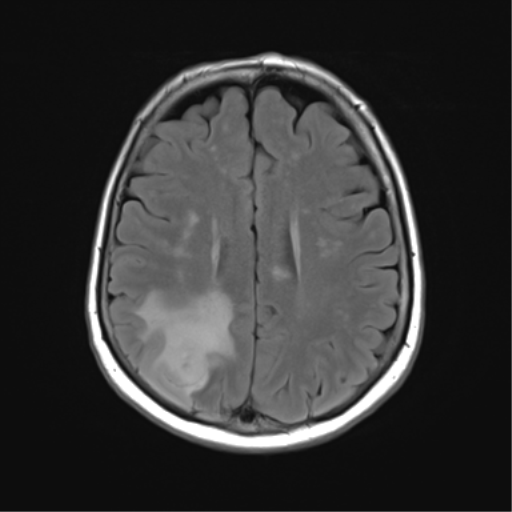 File:Anaplastic astrocytoma (Radiopaedia 86943-103160 Axial FLAIR 19).png