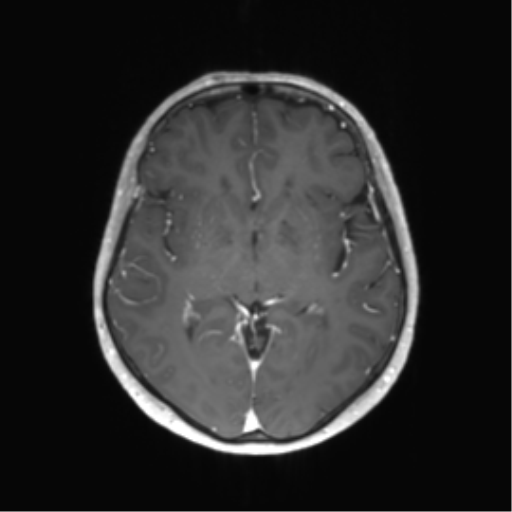 File:Anaplastic astrocytoma (Radiopaedia 86943-103160 Axial T1 C+ 23).png