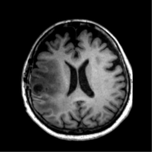 Anaplastic astrocytoma IDH wild-type (pseudoprogression) (Radiopaedia 42209-45277 Axial T1 82).png