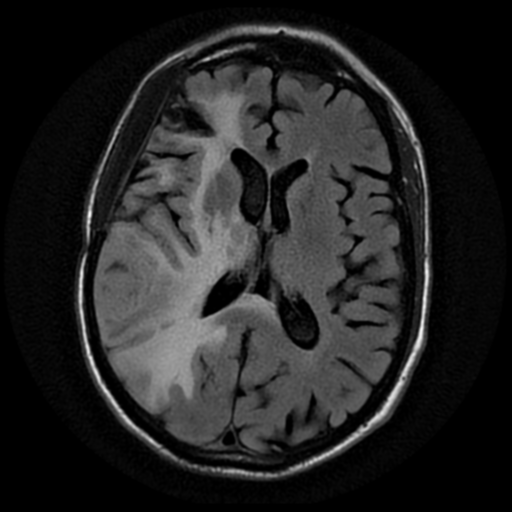 File:Anaplastic meningioma with recurrence (Radiopaedia 34452-35790 Axial T2 FLAIR 12).png