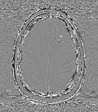 Anaplastic oligodendroglioma (Radiopaedia 83500-98599 Axial SWI - phase 63).png