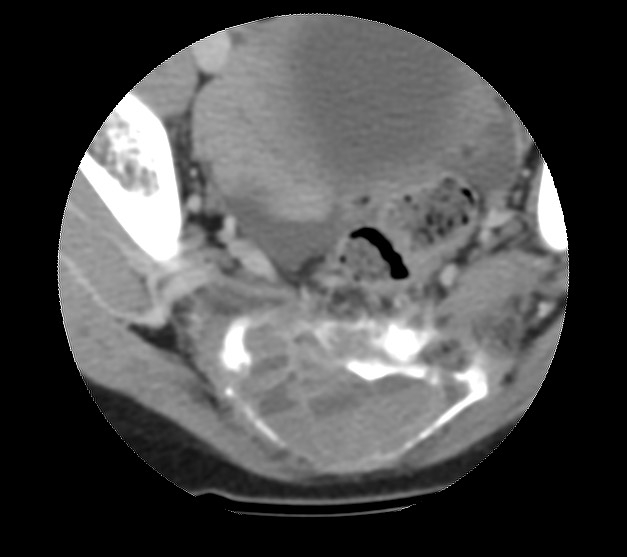 File:Aneurysmal bone cyst - sacrum (Radiopaedia 65190-74195 Axial non-contrast 32).jpg