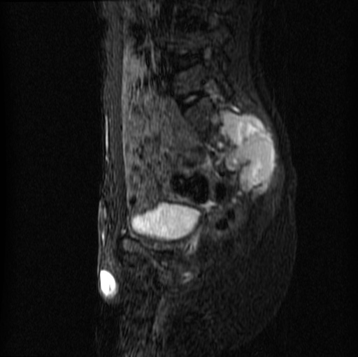 File:Aneurysmal bone cyst - sacrum (Radiopaedia 65190-74196 Sagittal STIR 14).jpg