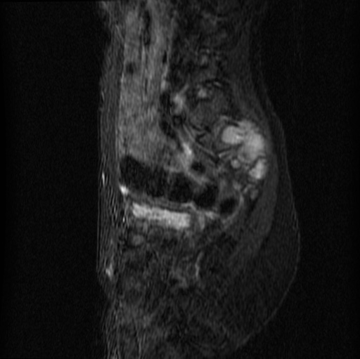 File:Aneurysmal bone cyst - sacrum (Radiopaedia 65190-74196 Sagittal STIR 21).jpg