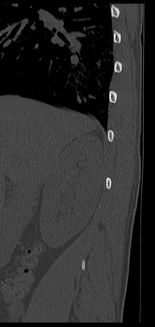 Aneurysmal bone cyst T11 (Radiopaedia 29294-29721 Sagittal bone window 76).jpg