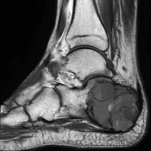 File:Aneurysmal bone cyst of the calcaneus (Radiopaedia 60669-68420 Sagittal T1 10).jpg