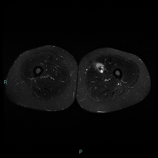 Angioleiomyoma (Radiopaedia 85442-101078 Axial STIR 42).jpg