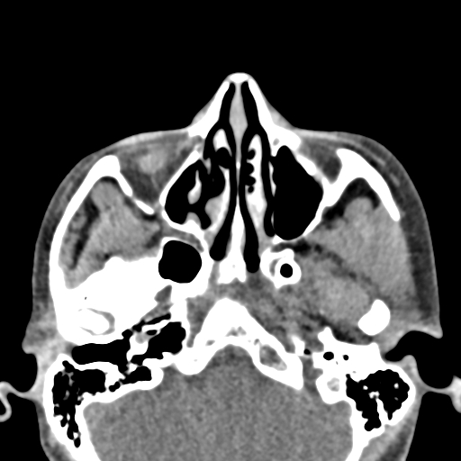 Angular dermoid cyst (Radiopaedia 88967-105790 Axial non-contrast 19).jpg