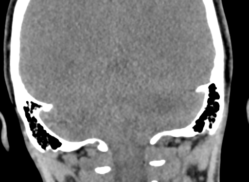 Angular dermoid cyst (Radiopaedia 88967-105790 Coronal non-contrast 92).jpg