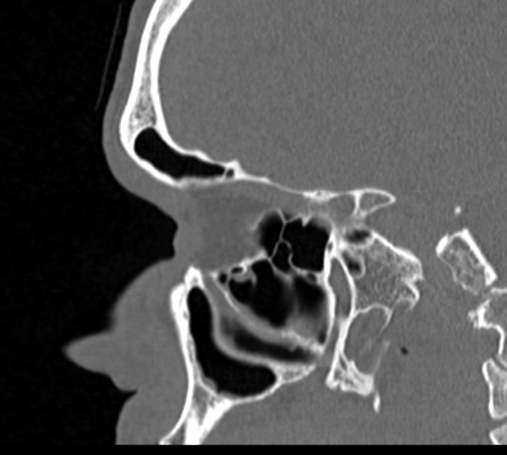 Angular epidermoid cyst (Radiopaedia 46908-51439 Sagittal bone window 58).png