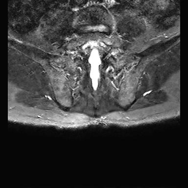 File:Ankylosing spondylitis with zygapophyseal arthritis (Radiopaedia 38433-40517 D 12).jpg