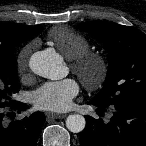 File:Anomalous origin of the left coronary artery with malignant course (Radiopaedia 77842-90126 C 64).jpeg