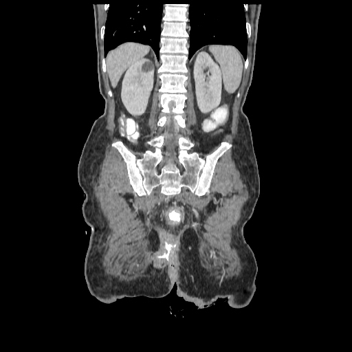 Anorectal carcinoma (Radiopaedia 44413-48064 B 67).jpg
