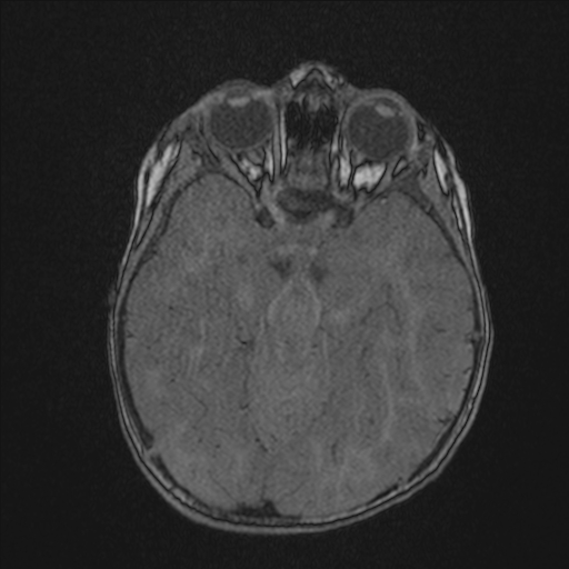 Anoxic brain injury (Radiopaedia 79165-92139 Axial MRA 85).jpg