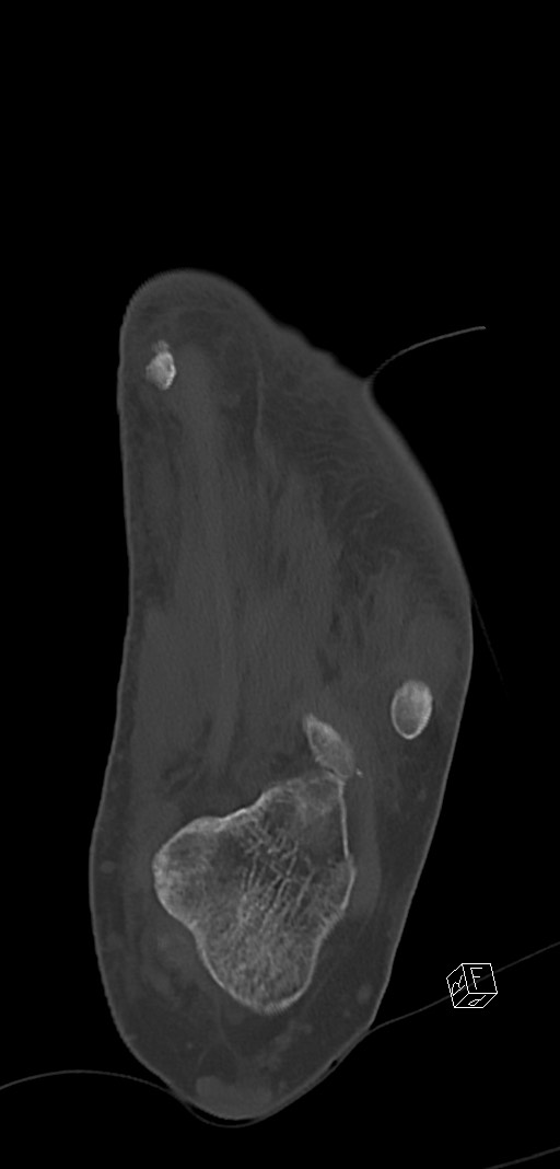 Anterior calcaneal process fracture (Radiopaedia 63353-71943 Coronal bone window 34).jpg