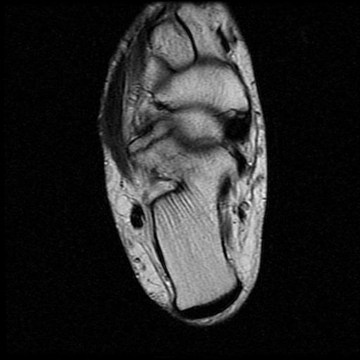 File:Anterior calcaneal process fracture (Radiopaedia 71377-81705 Axial T2 11).jpg