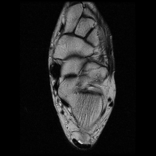 File:Anterior calcaneal process fracture (Radiopaedia 74654-85611 Axial T2 16).jpg