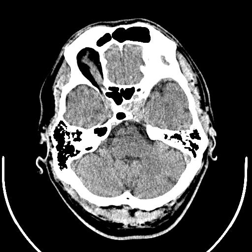 Anterior choroidal artery infarct (Radiopaedia 55106-61480 Axial non-contrast 11).jpg