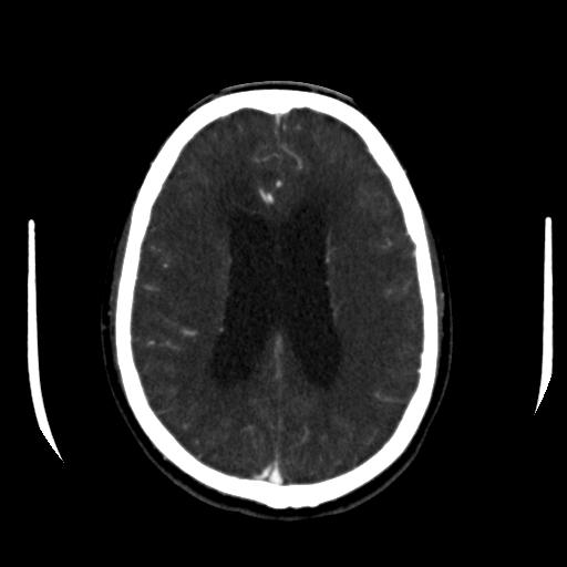 File:Anterior communicating artery aneurysm (Radiopaedia 16633-16335 A 29).jpg