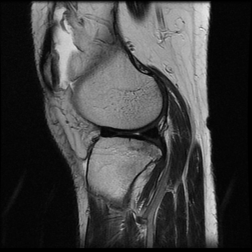 File:Anterior cruciate ligament avulsion fracture (Radiopaedia 58939-66193 Sagittal T2 7).jpg