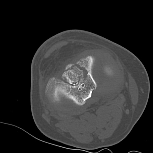 File:Anterior cruciate ligament avulsion fracture (Radiopaedia 58939-66194 Axial bone window 16).jpg