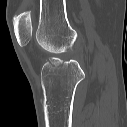 File:Anterior cruciate ligament avulsion fracture (Radiopaedia 58939-66194 Sagittal bone window 19).jpg