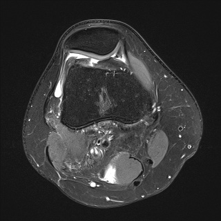 File:Anterior cruciate ligament rupture and posteromedial corner injury (Radiopaedia 67338-76723 Axial 6).jpg
