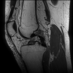Anterior cruciate ligament rupture with Segond fracture (Radiopaedia 69043-78806 Sagittal PD 92).jpg